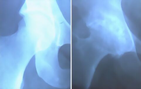 Scum vun Arthrosis vum Knéi Gelenk