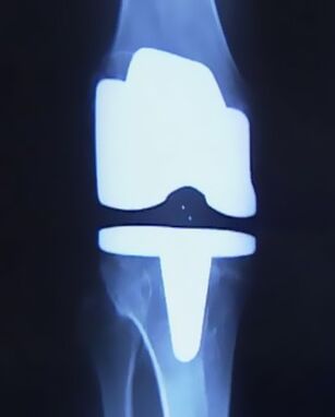 X -ray Bild vum Knéi mat enger künstlecher Prothesis no der Operatioun fir de Gelenk z'änneren