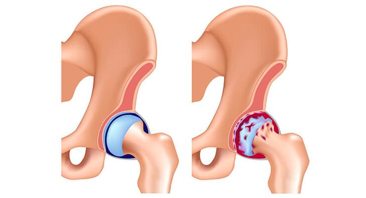 gesond an arthrosis-betraff Hip Gelenk