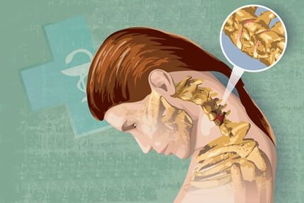 Reflex Symptomer vun Osteochendrosis